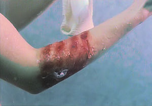 The burn on Danni's arm looks like fingers