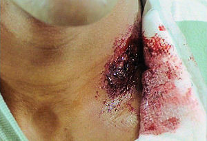 Aguinaldo's neck wound